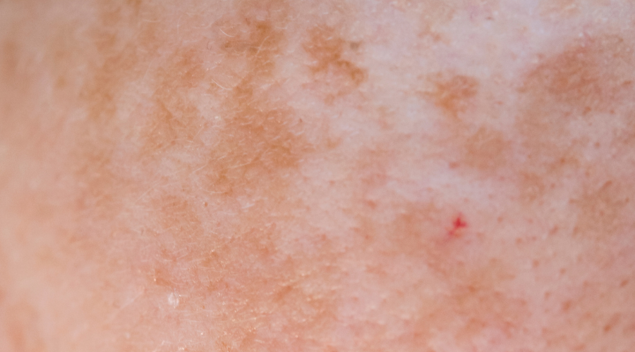 Salapärane püsikaaslane dermatiit. Foto: Canva